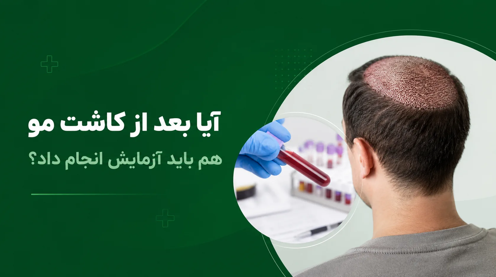 آیا بعد از کاشت مو هم باید آزمایش انجام داد؟